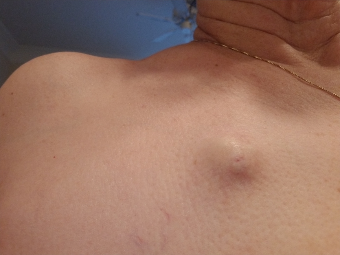 Medical Chemotherapy Port Under Skin On Chest Of Young Man High