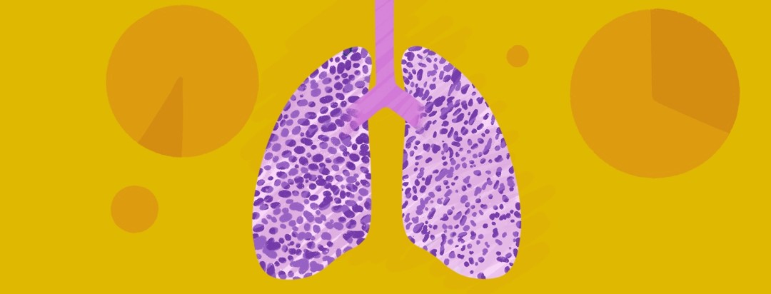 A pair of lungs showing small cell lung cancer with charts in the background