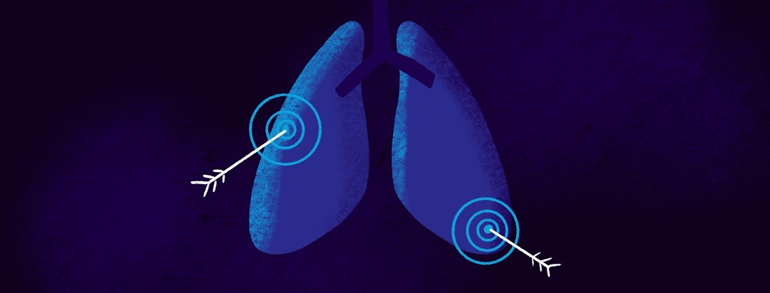 A pair of lungs with two targets, both have an arrow in the bullseye