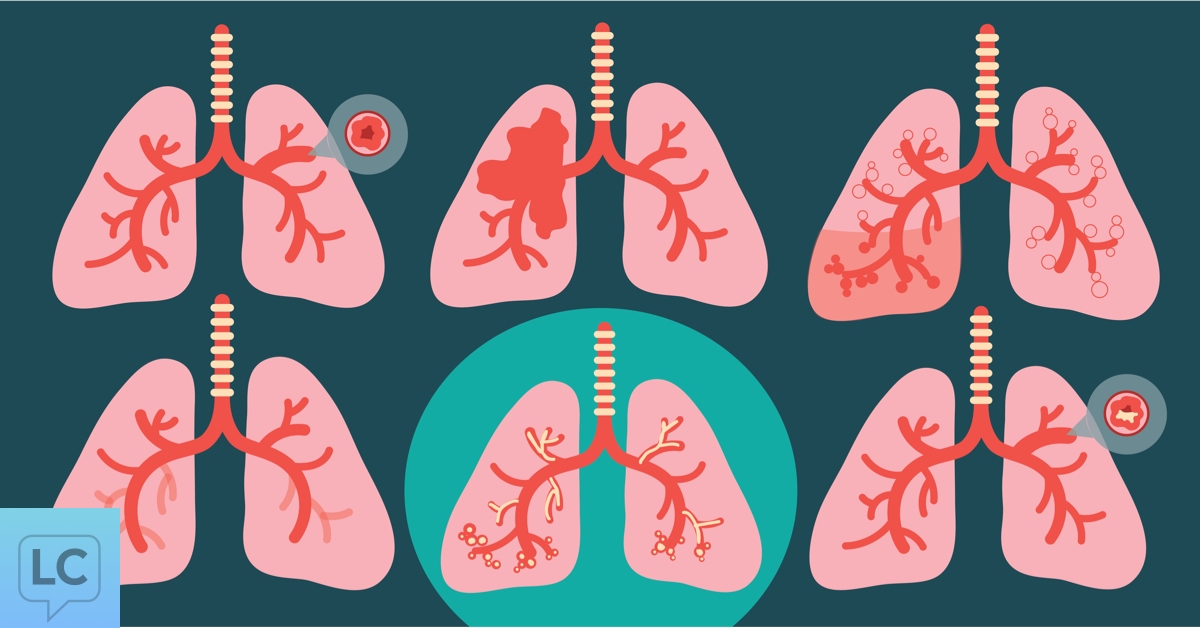 Do Targeted Therapies Reduce Lung Cancer Death Rates?