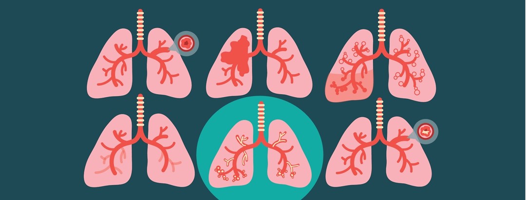 6 pairs of lungs with different conditions