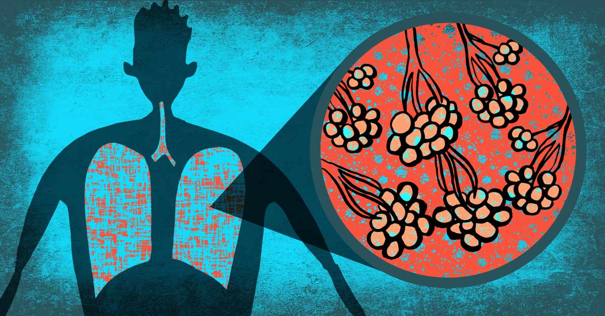 When And How Are Needle Biopsies Used For Lung Cancer?